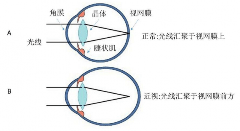 防控近視的離焦眼鏡有用嗎？